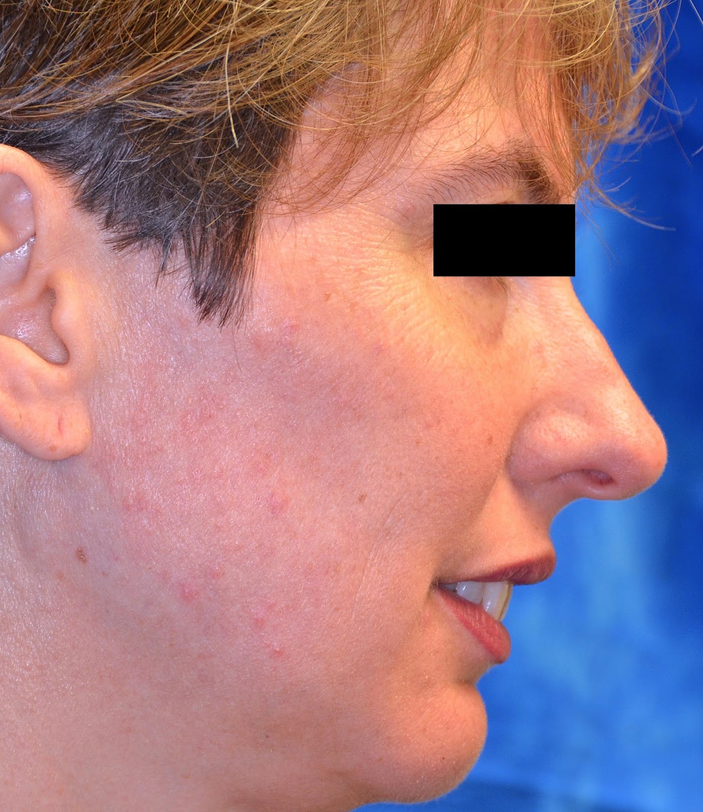 ivermectin in dermatology treatment ivermectin in dermatology treatment